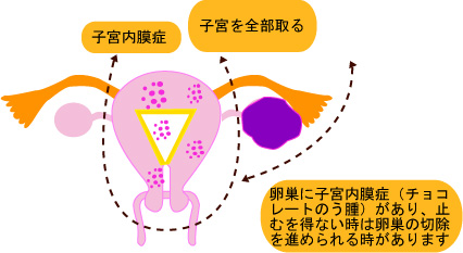 卵巣 の う 腫 症状 チェック